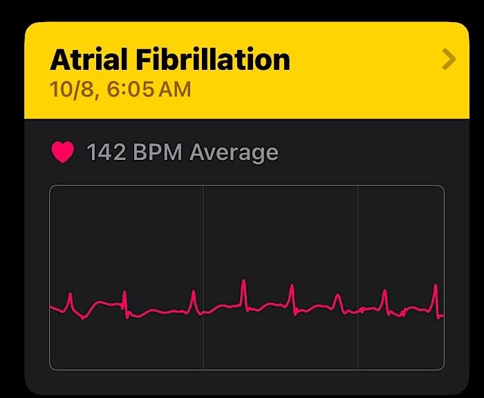 Résultat Afib de vies sauvées par Apple Watch