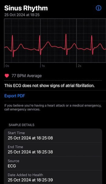 Graphique Ecg Apple Watch